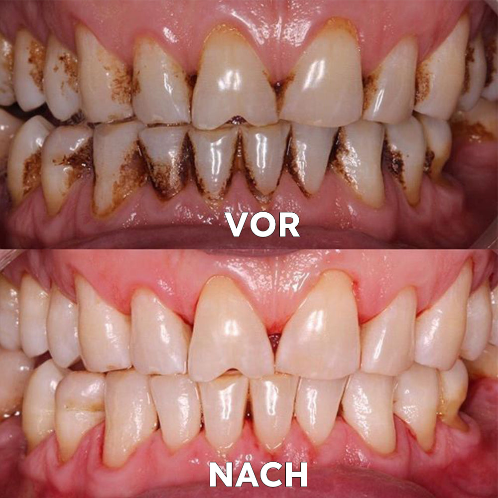 ✅ Seurico™ Gum Repair & Oral Health Powder (CE-certified for Periodontitis, Mouth Ulcers, and Gum Recession)