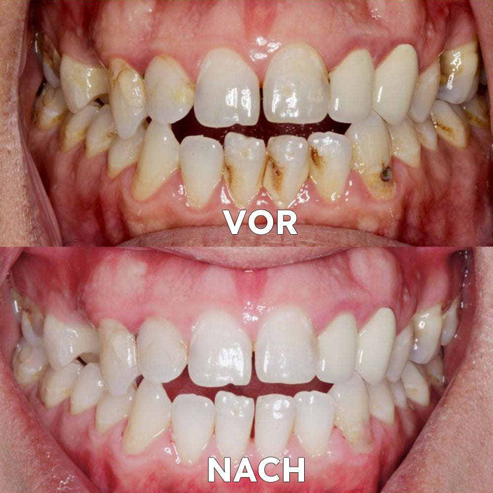 ✅ Seurico™ Gum Repair & Oral Health Powder (CE-certified for Periodontitis, Mouth Ulcers, and Gum Recession)
