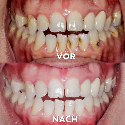 ✅ Seurico™ Gum Repair & Oral Health Powder (CE-certified for Periodontitis, Mouth Ulcers, and Gum Recession)